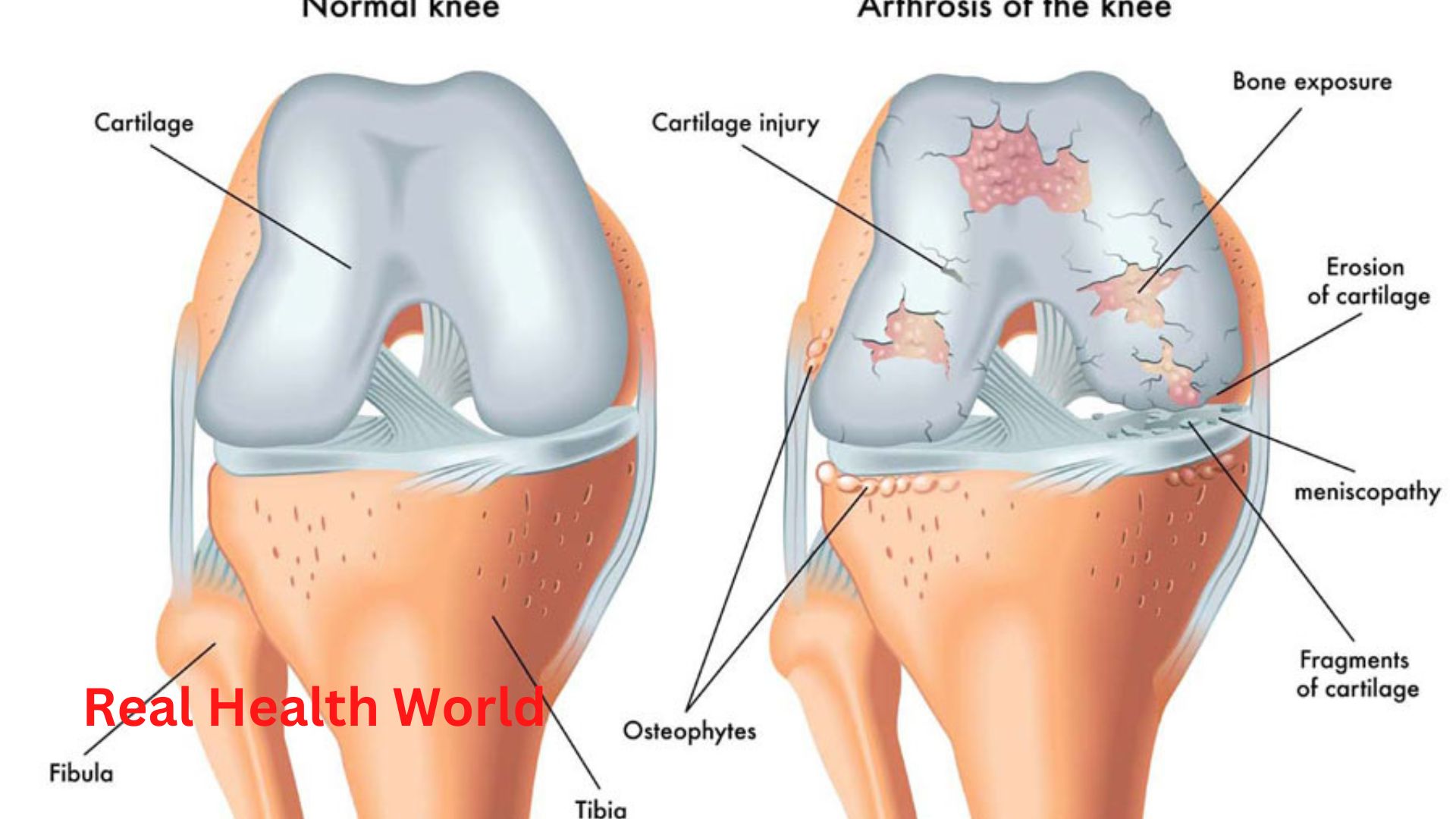 The role of physiotherapy in the treatment of osteoarthritis