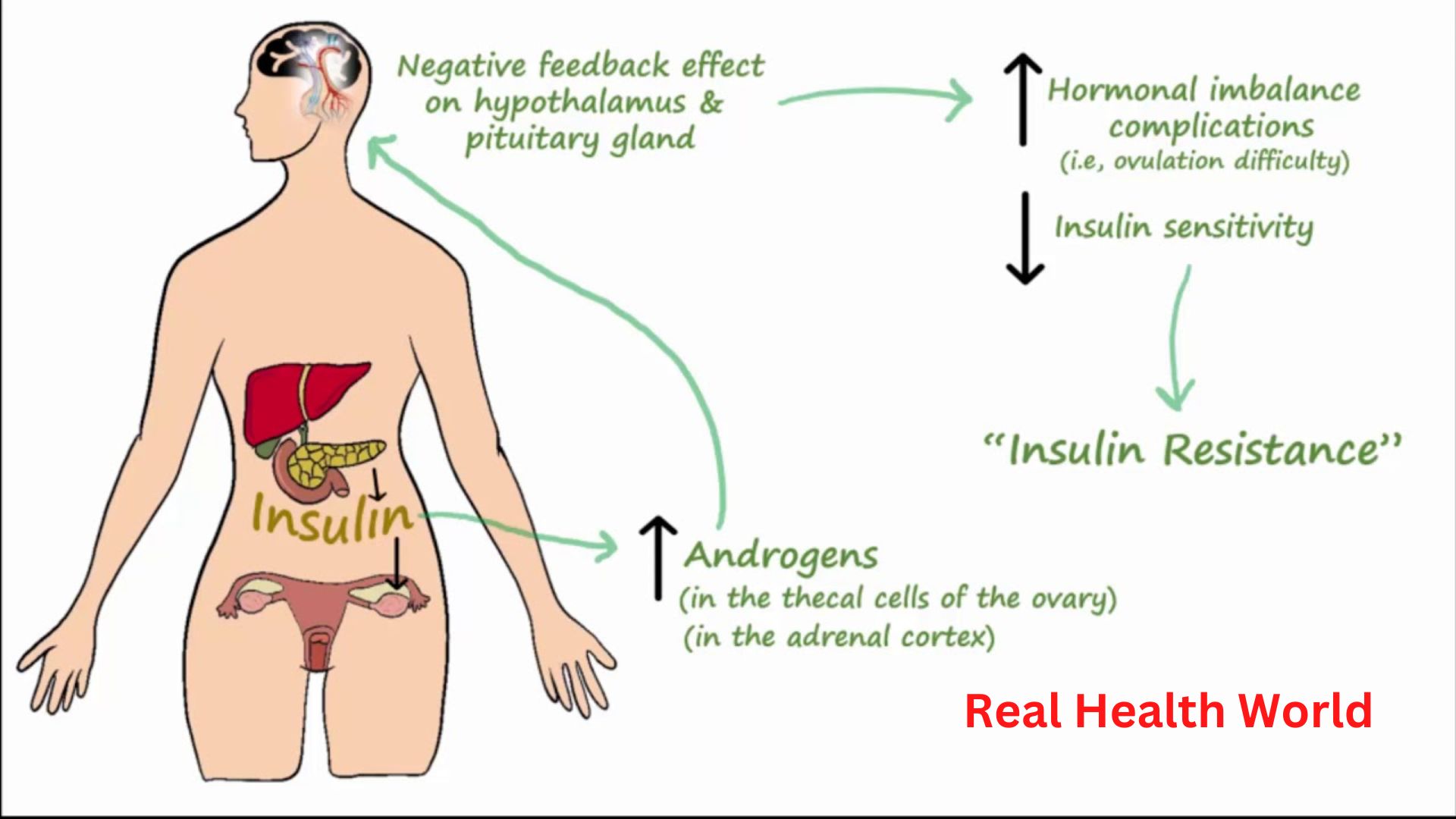 PCOS is a hormonal problem