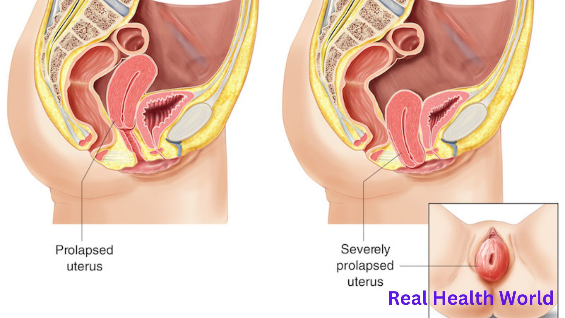 What to do if the uterus descends