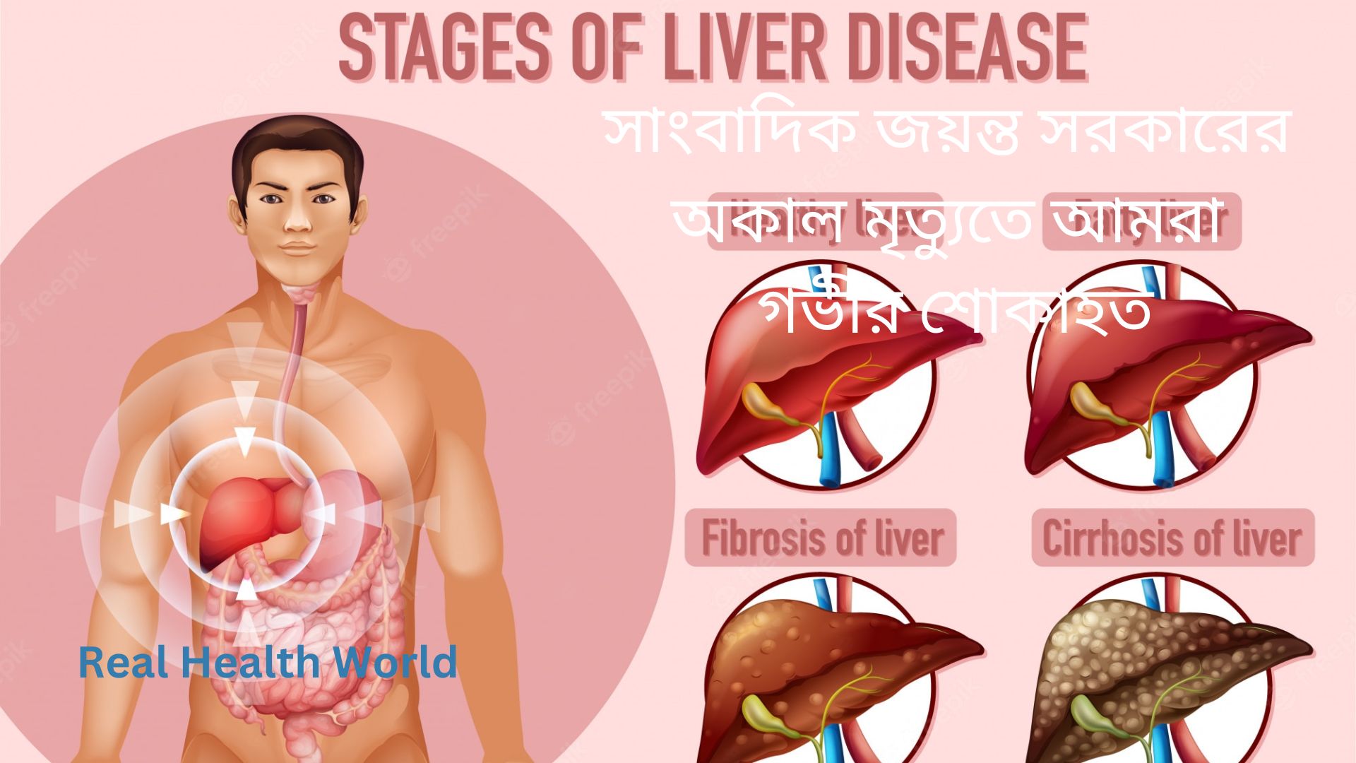 Causes and treatment of fatty liver