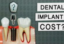 The Best Affordable Dental Implants: A Comprehensive Guide