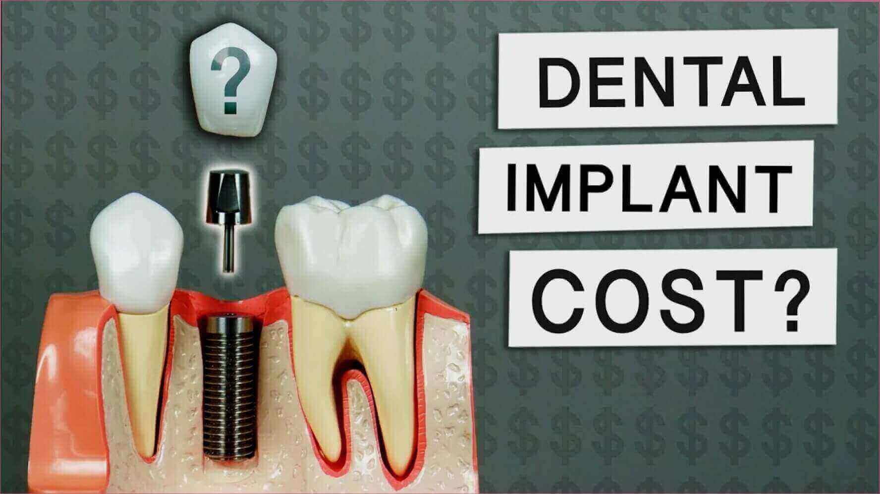 The Best Affordable Dental Implants: A Comprehensive Guide